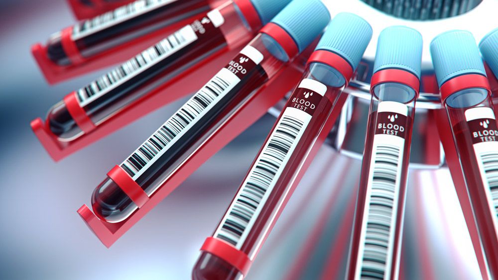 Nuovo test del sangue rileva la SLA prima